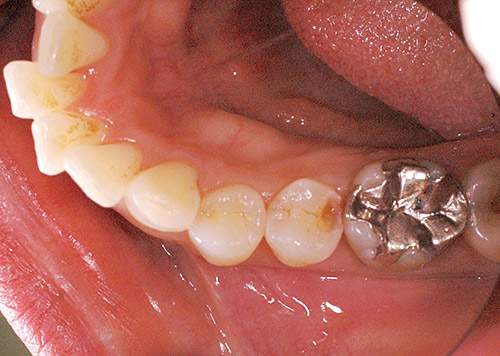 軟化象牙質を除去後、確認のためう蝕検知液で染め出して、う蝕を取り除いた写真