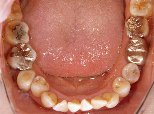 歯周治療のメインテナンス中の患者の口腔内写真