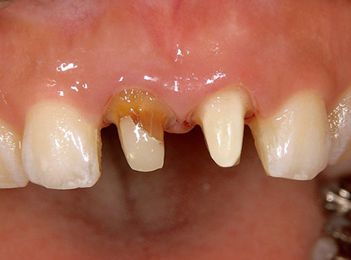 上顎左右中切歯にファイバーポストレジンコアにて支台歯を修復した写真