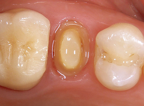 上顎左側第二小臼歯にファイバーポストレジンコアにて支台歯を修復した写真