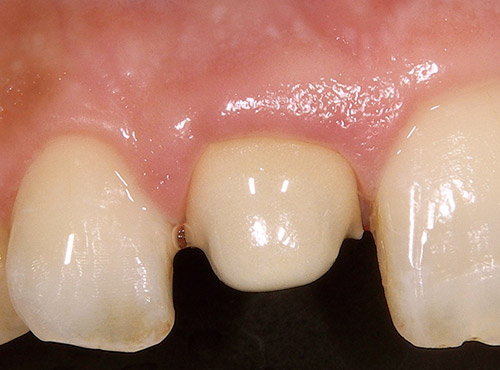 自然な発色と歯肉との調和が確認できる