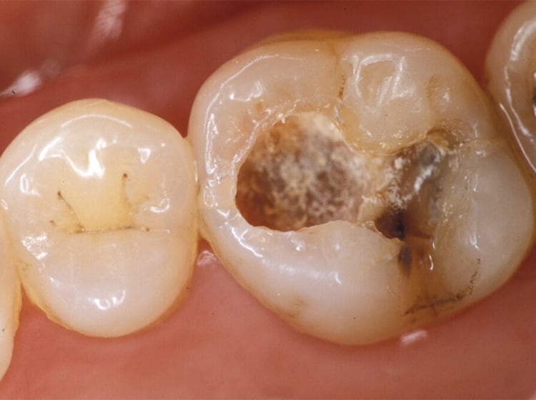 深く、多量の感染象牙質をもつう窩で、抜髄を考えるような場合でも、一定の条件があれば、無麻酔下で完全に崩壊した象牙質取り除き、水酸化カルシウム剤を置いて数ヵ月の暫間的な修復を行ってみる。