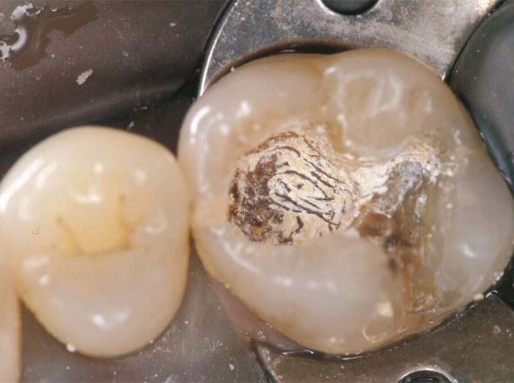 経過観察し、3~6ヵ月後、麻酔下で再開拡し、窩底の象牙質を通法で除去して行くと、最石灰化して硬化した象牙質が得られる（これらをIPC法と称し、健康保険ではA‑IPC法として収載している）。