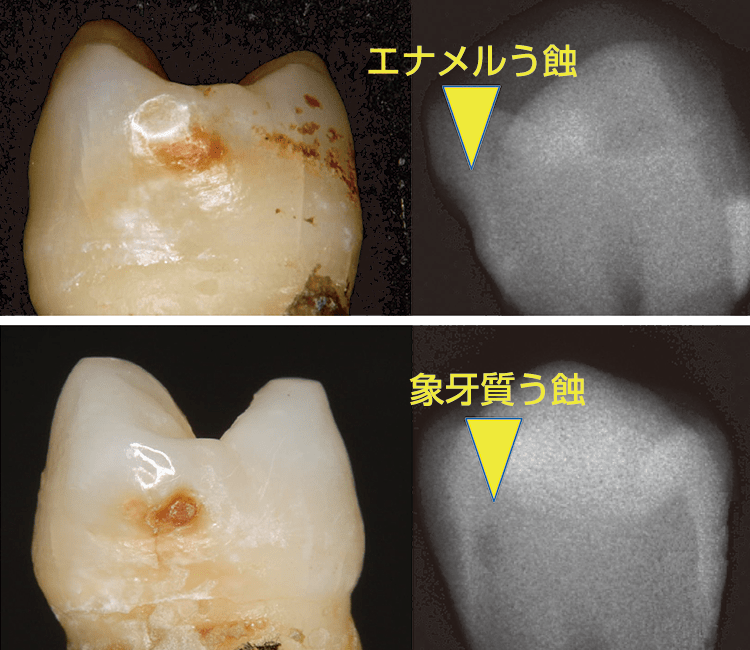 エナメル質う蝕をもつ歯（上）、象牙質う蝕をもつ歯（下）を各々従来のダイアグノデント（咬合面プローブで）とダイアグノデント ペン（隣接面プローブで）測定した。