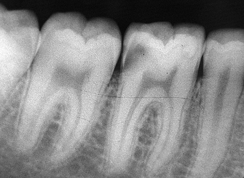 第一大臼歯に主軸を合わせたレントゲン写真