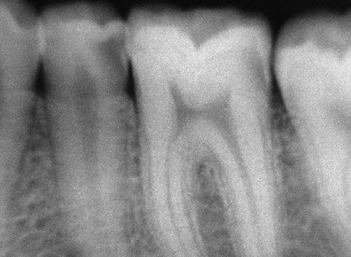 小臼歯と大臼歯のレントゲン写真