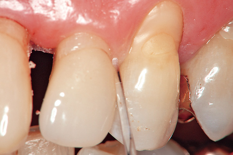 図7a 患者は75歳の男性患者で35年以上に亘り、受診している。最近は歯周の管理を中心に3ヵ月間隔でリコールしている。ペリオプローブを用いて検査した。