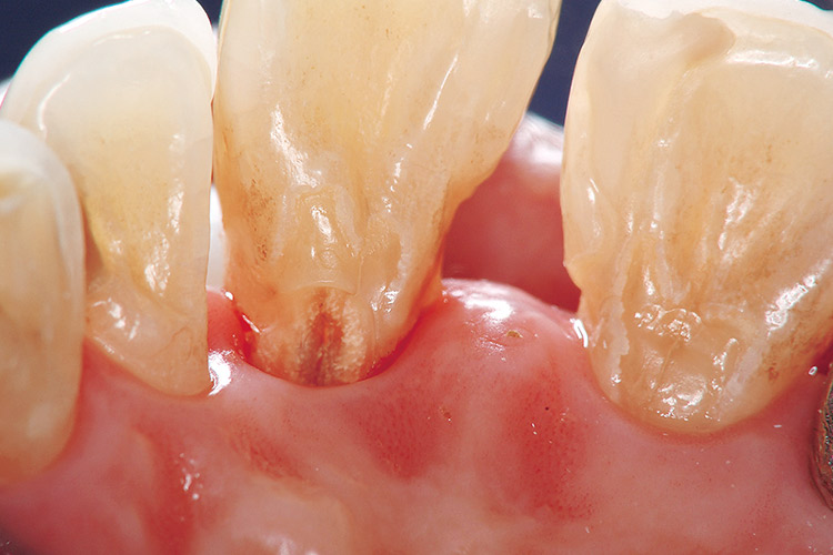 図7b 比較的管理が行き届いているが、根面う蝕が見られるようになり、歯石などの検査とポケット内のう蝕の検査も必要になった。左上1番口蓋側の根面う蝕。
