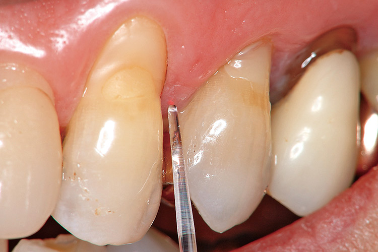 図7c 清掃後、ポケットが深い部位を中心にペリオプローブを用いて歯石と根面のう蝕を検査していく。歯軸に対して平行に、歯面に軽く沿わせてポケットに挿入していく。
