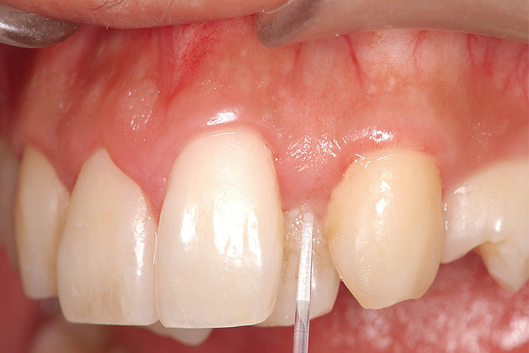 図8b 舌側転位している左上2番には歯冠唇面にもプラークの蓄積が著しいが、ポケット内のプラークも著しく、ピーク値は52であった。
