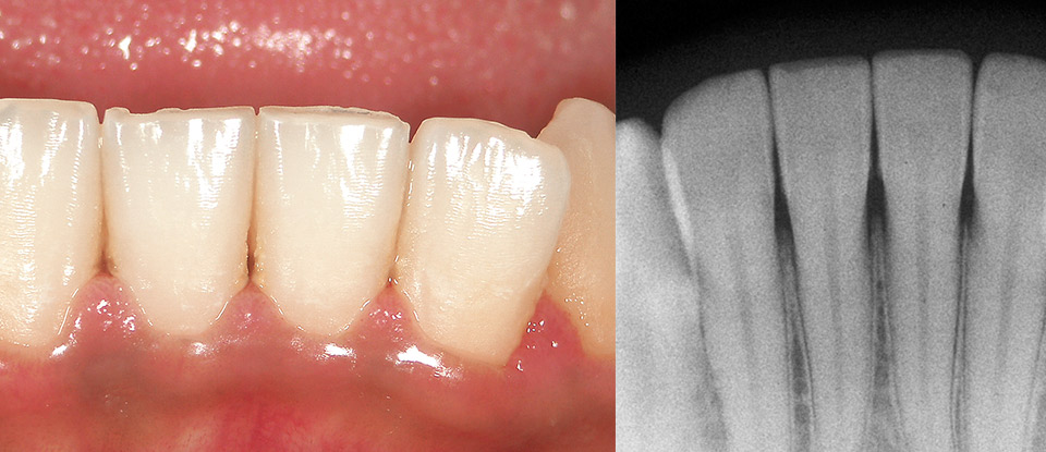 図9a 患者は23歳男性で、「歯茎が気になる」と来院した。念のため訴えの部位の下顎前歯部のX線写真を撮影した。鮮明ではないが縁下歯頸部に歯石らしきものを認めた。