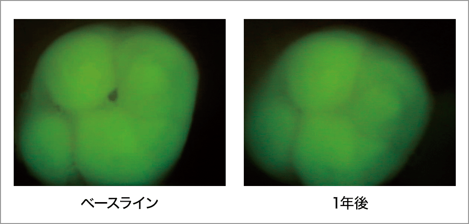 図9 POs‑Ca+F配合ガム咀嚼1年間の第一大臼歯咬合面の一例 初期う蝕の再石灰化の QLF（光誘導蛍光定量法）画像