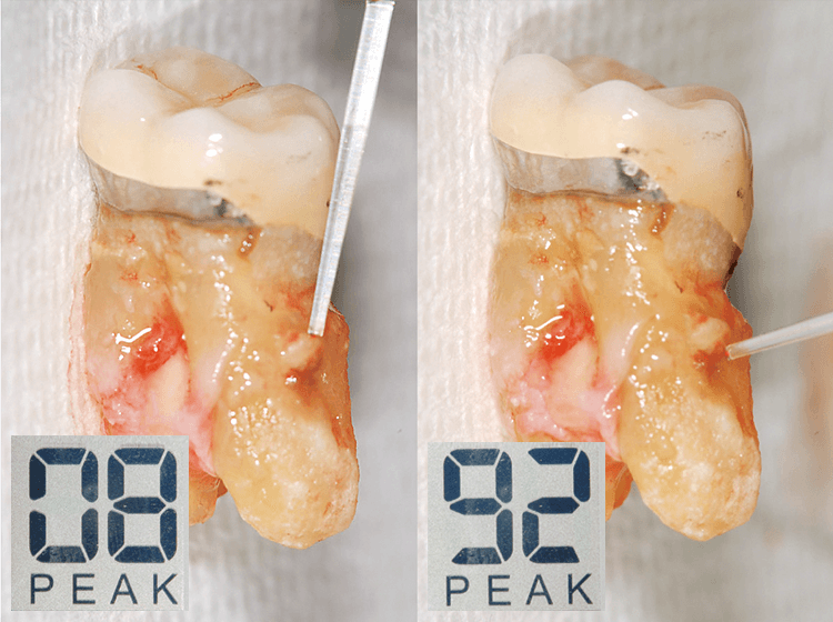 6 抜歯時に確認。レントゲンに写っていた凸面はエナメルパールで数値は8、エナメルパールの下に沈着する歯石の数値は92。