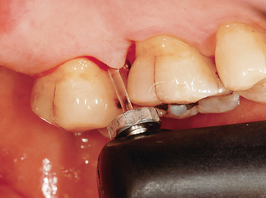 SRP後、ダイアグノデント ペン ペリオプローブで歯根面の状態をチェックする。血液の数値への影響はほとんどない。