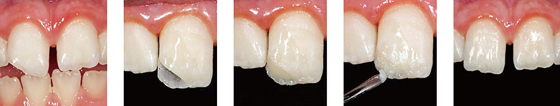 写真②　破折歯以外は必要以上に手を加えることなく修復された症例。＜モーガン先生症例＞
