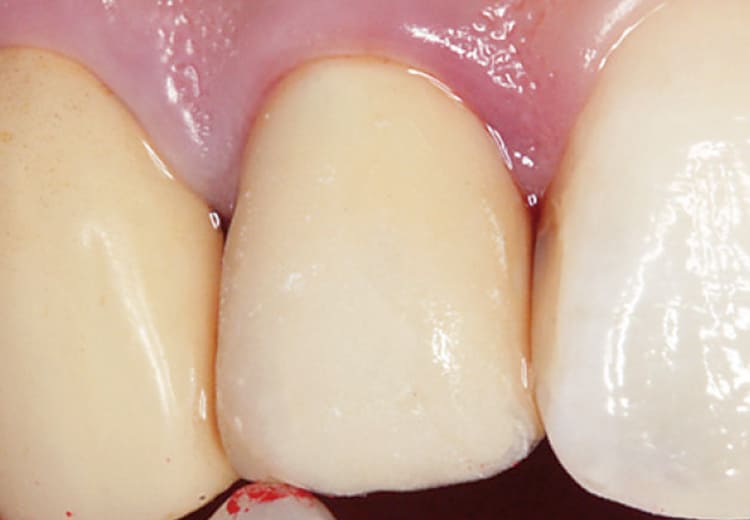 歯頸部に「サービカル」歯冠部には「ミディアム」を積層充填。