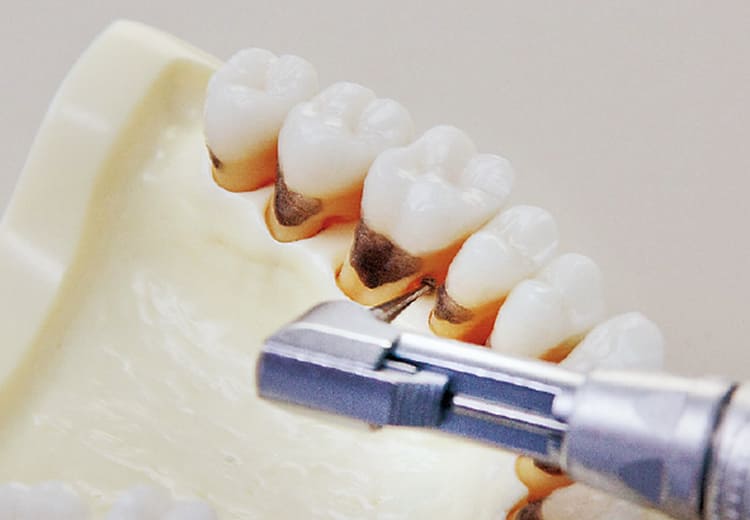 ラウンドバー小：分岐部のデブライトメント・小さい根面溝、歯根陥凹部のデブライトメント。