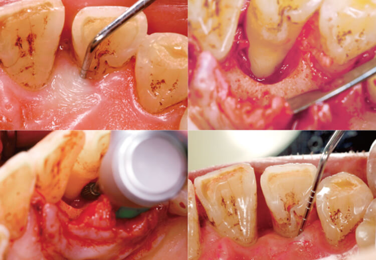 9mmのポケット囲業尭性の骨欠損内を歯周外科用根面バーにて根面の処理と肉芽組織を取り去ったところ。ポケットが2.5mmに改善している。