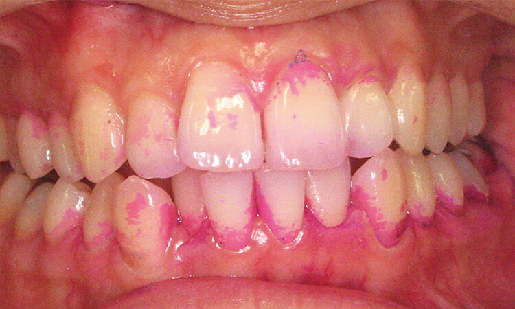 症例2：20歳代女性、ブラッシング前。辺縁歯肉に軽い発赤がある歯肉炎。歯頸部に沿ってプラークが認められる。