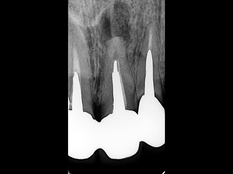 ＃21に直径8mm×8mmの嚢胞用透過像が見られる。補綴後再治療したが初回のメタルコアが除去しきれず、症状緩解後連結固定を受けるが再度症状の再発をみる。抜歯を勧められる。