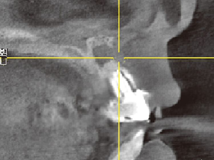 同CT像。頰側の一部骨の吸収像が見られる。メタルコアは根尖近くまで合着されており、除去の困難が予想される。
