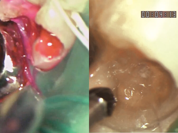 左：ラバーダム防湿下で感染歯質を除去していく。右：マイクロスコープ下で感染歯質を除去していく。