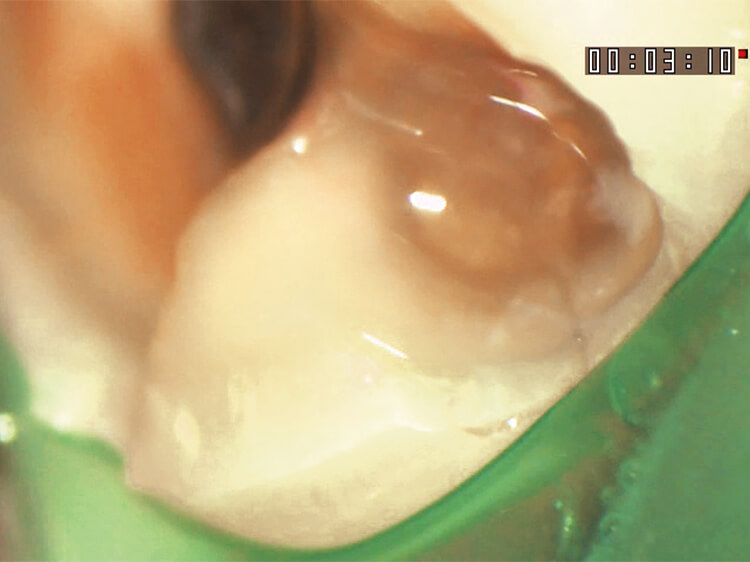 う蝕検知液には染色されてはいないが、歯質にマイクロクラックが認められる。患者さんとの情報共有に大きな影響を与えてくれる。
