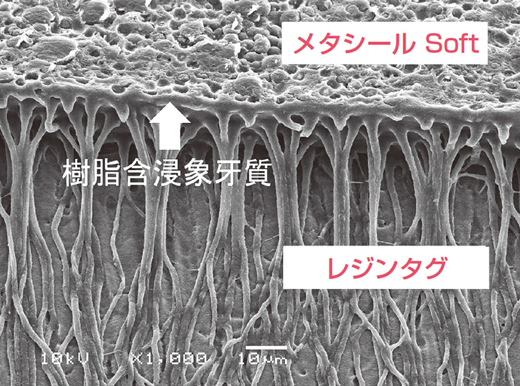 図5　メタシールSoftはレジンタグおよび樹脂含浸象牙質を形成して根管象牙質壁と接着する。