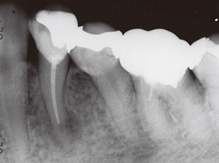 図9　左側下顎第一小臼歯の術前X線写真。根尖を取り巻くX線透過像を認める。