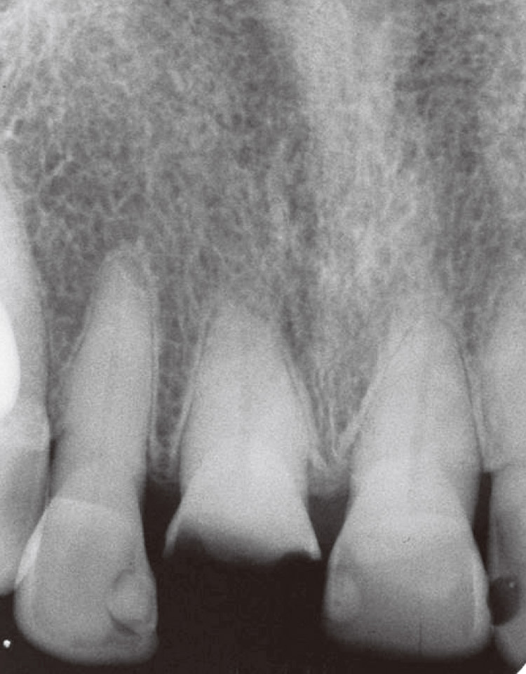 図13　78歳女性の右側上顎中切歯の術前X線写真。歯冠破折により来院した。