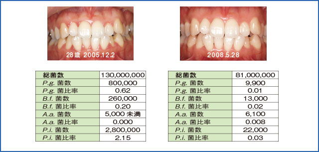 口腔内の実際：侵襲性歯周炎を疑ったケースの細菌検査の結果表