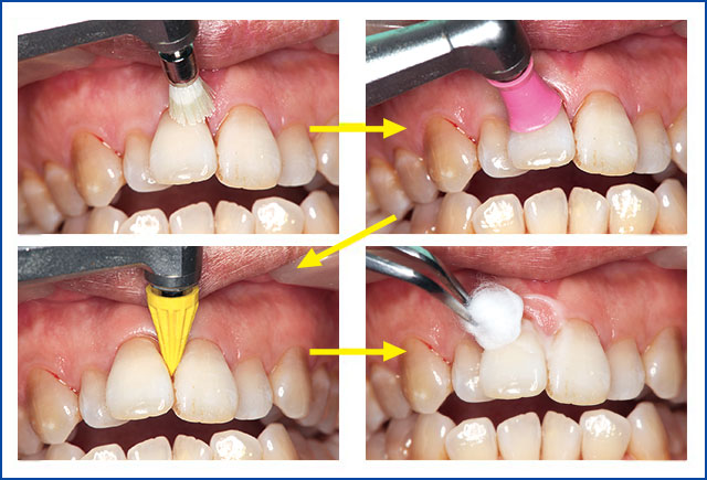 歯面研磨の仕上げとしての活用事例の写真
