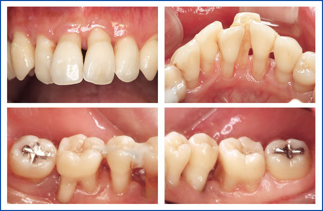 SPT期患者さんの口腔内事例の写真