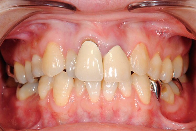 図1　術前正面観。11はボーンハウジングから逸脱し歯肉退縮を起こしている。審美的に改善するためには歯頸線を整える必要がある。
