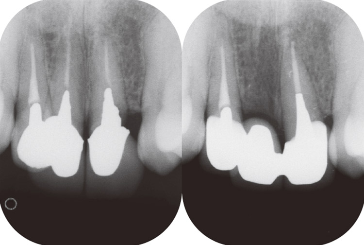 図5　術前・術後のデンタルX線写真の比較。12は抜歯となった。
