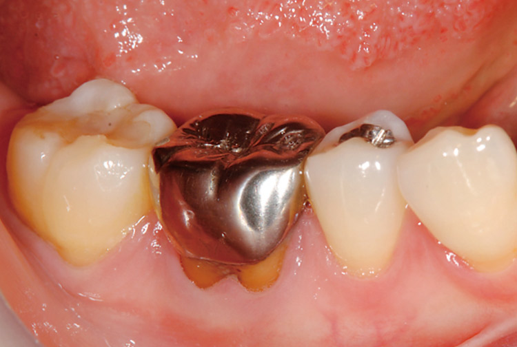 図7　術前口腔内写真。10年以上前に装着されたメタルクラウンであるが、歯肉は退縮し、患者は大きく開口した際の審美障害を訴えていた。