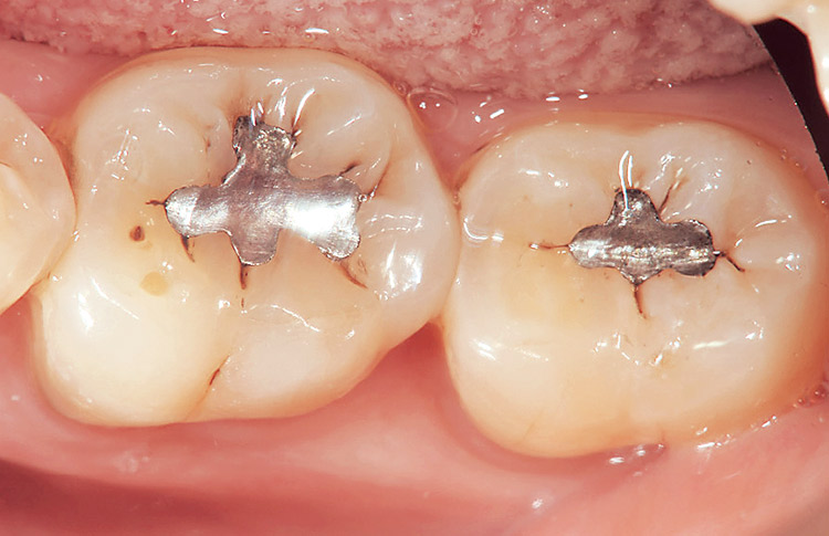 図1　下顎第一・第二大臼歯の咬合面にアマルガム充填と周辺に二次う蝕が認められる。