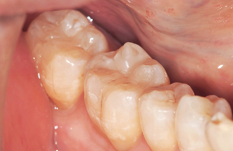 図12-2　咬合調整と研磨を行った術後の状態（咬頭と窩の形態がわかりやすい角度の写真）。