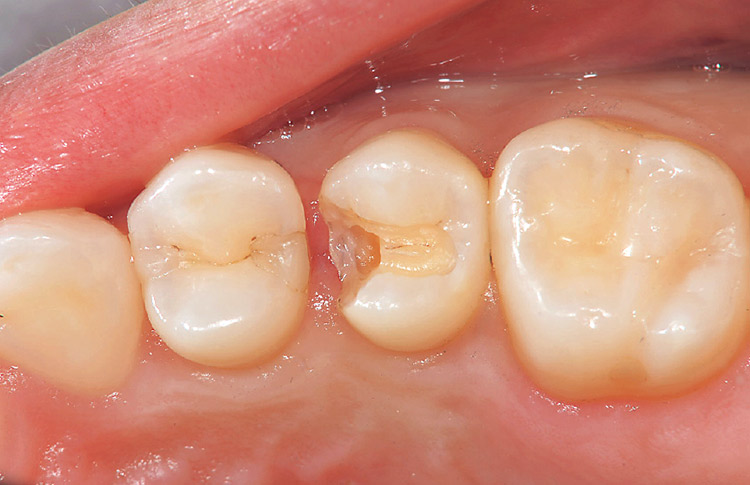 図14　メタルインレーを除去し感染象牙質も除去された窩洞。