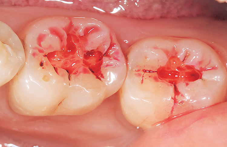 図3　う蝕検知液にて感染象牙質を確認する。