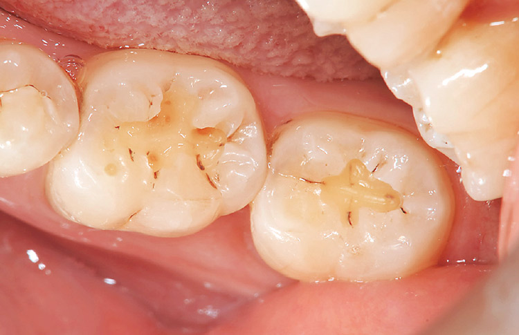 図4　う蝕検知液で染色された感染歯質が除去された窩洞。