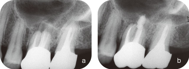 左上第一大臼歯の根管充填の写真