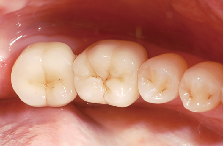 図10　CZRを築盛し焼き付けたクラウンはエナメル質領域において天然歯（ここでは前方の小臼歯が天然歯）と近似した色調を呈している。