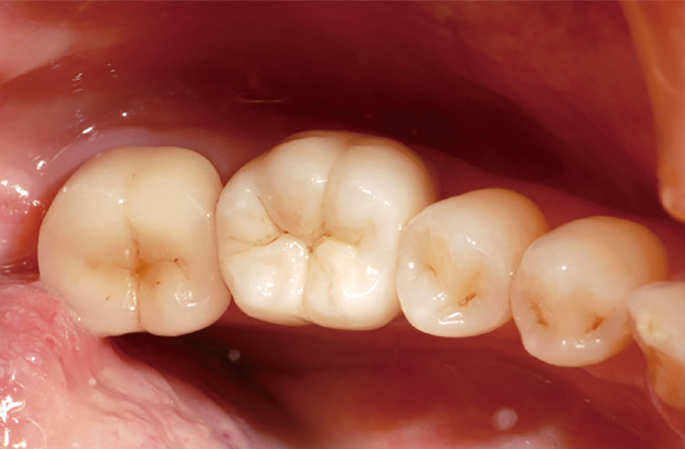 図12　ML A-Lightを使用し、CZRプレス-LFエクスターナルステインにて着色したクラウンはやはり隣在歯と比べて明るく目立つ。