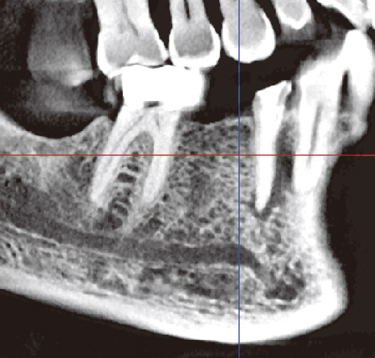 図9　断面厚を2.0mmで表示し、無歯顎の顎骨の観察に向いている。