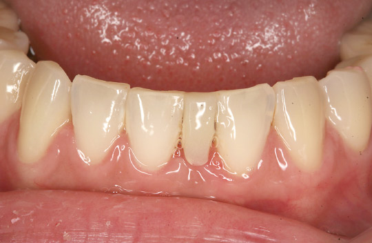 図1　初診時の口腔内初見。患者は先天的な永久歯欠損で、乳歯を代用歯としていたが保存不能となり抜歯。その後審美性の改善のためブリッジによる修復となった。