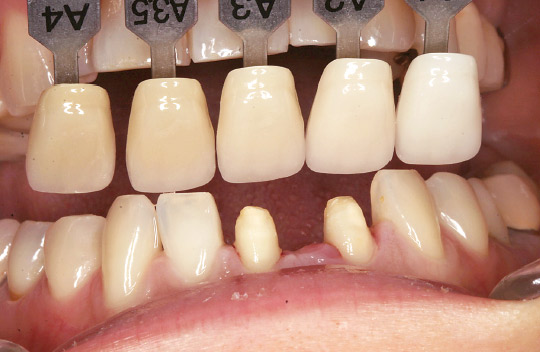 図2　支台歯形成後の状態と比色シェード
