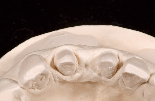 図3　補綴物製作用の模型。特に右下中切歯は修復スペースが非常に少ない。