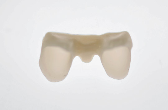 図6　図5の舌側から光を当てたところ。厚さ0.4mmながら透過性があり、下地となる支台歯の影響を受けることが予想される。