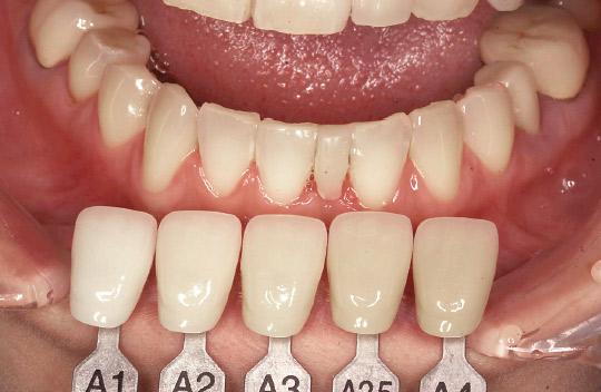 図8　歯科医師より送られた比色写真。近似したシェードはA1とする。